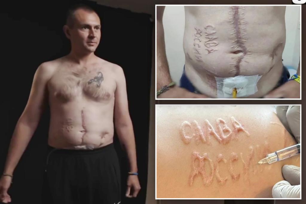 Ukrainian POW branded with ‘Glory to Russia’ says torture left him begging for death