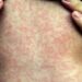 Measles 'out of control,' experts warn, as Alberta case counts surpass 1,000 | CBC News