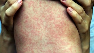 Measles 'out of control,' experts warn, as Alberta case counts surpass 1,000 | CBC News
