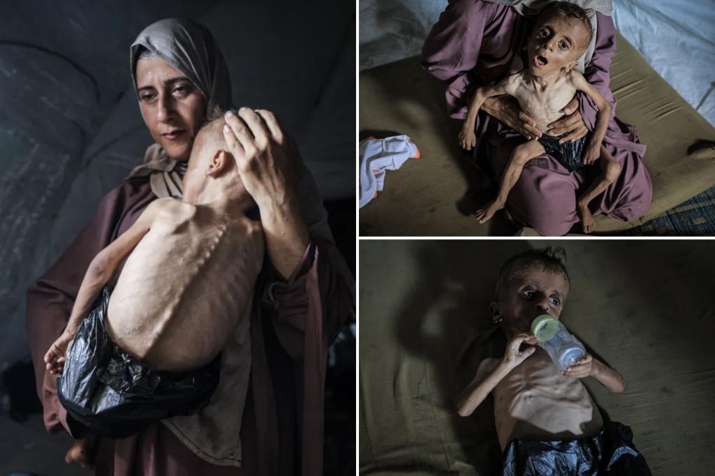 Viral images of starving Gaza boy don’t tell the whole story because he suffers from genetic disorders, critics say