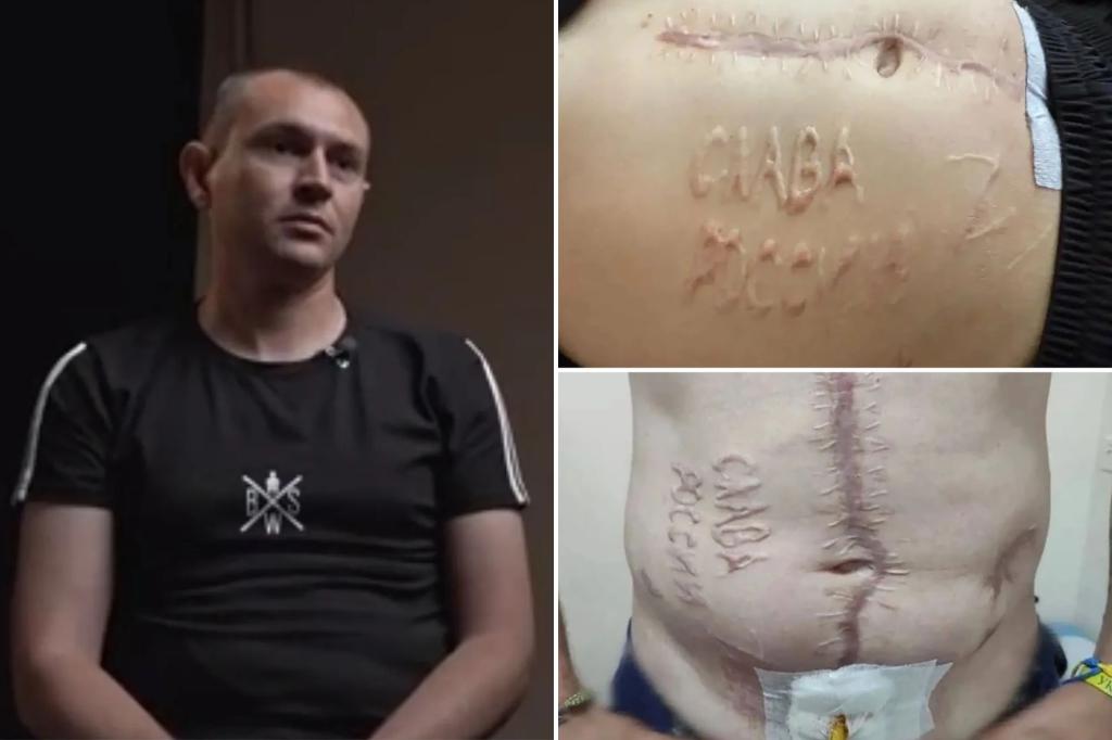 Exclusive | Tortured Ukrainian POW branded with ‘Glory to Russia’ vows to return to battle after recovery: ‘Thirst for revenge’