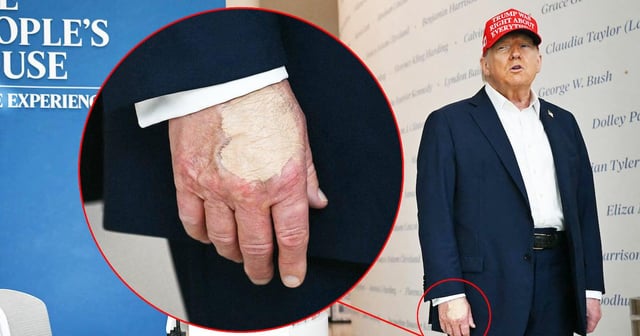 Trump, 79, Smears Right Hand In Makeup Amid Cankles Cover-Up