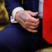Trump reveals dark bruising on hand as he goes cover-up-free in Oval Office