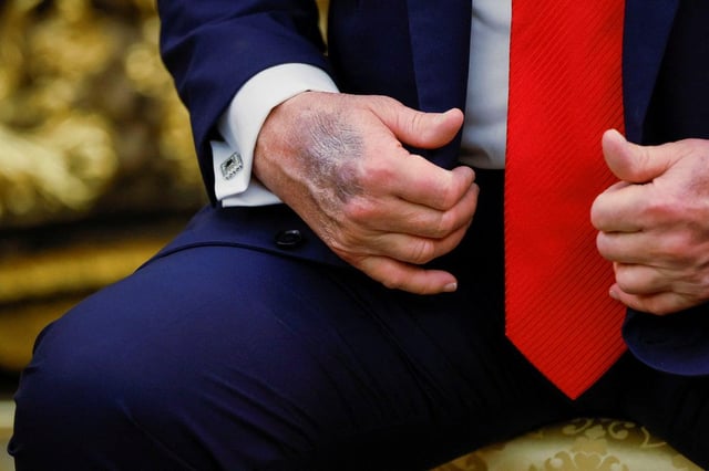 Trump reveals dark bruising on hand as he goes cover-up-free in Oval Office
