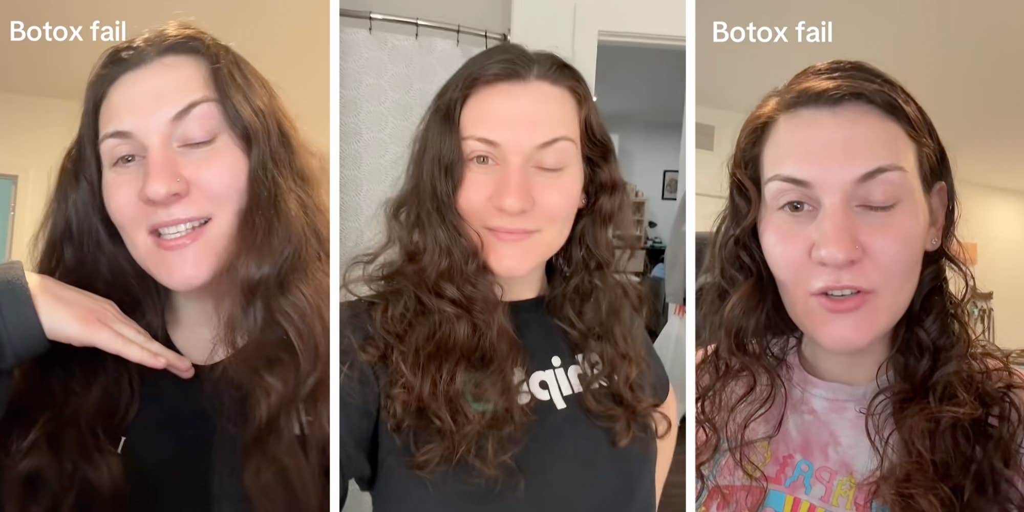 Woman shares warning after "botox fail" leaves her with one closed eye