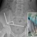 13-year-old boy has emergency surgery after swallowing 100 magnets