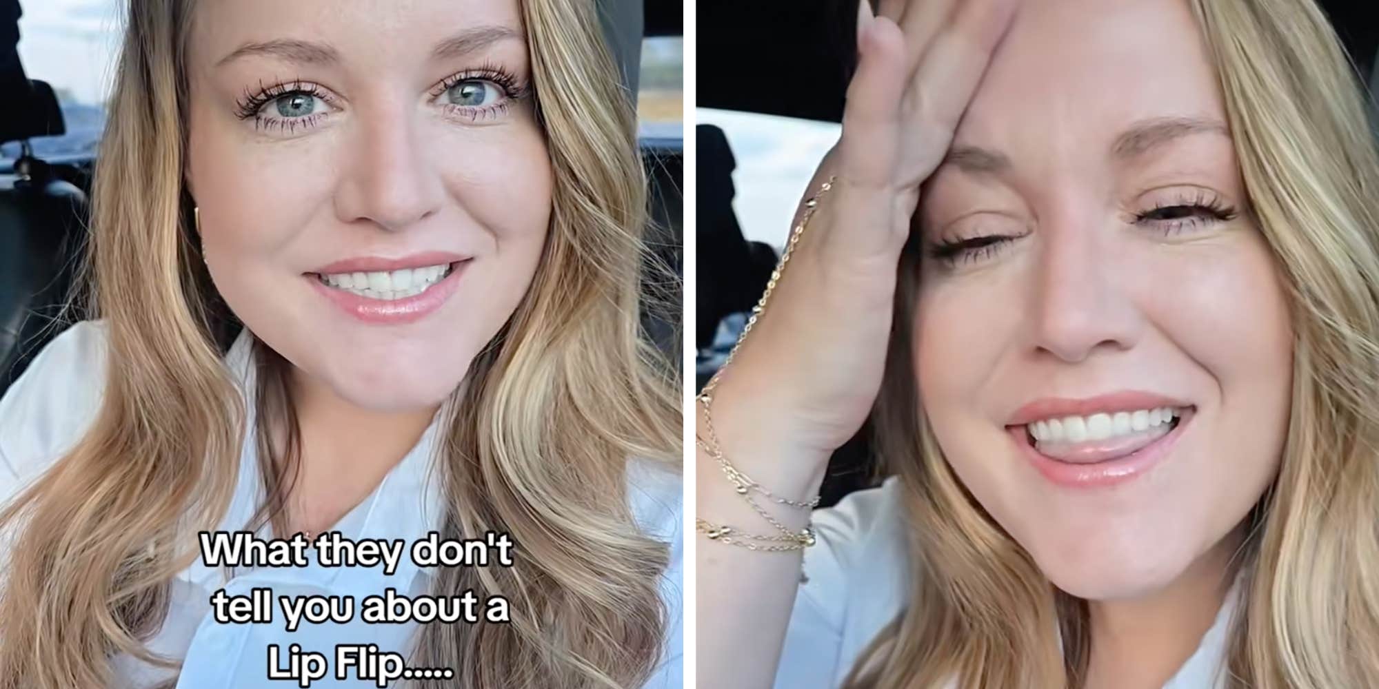 "Need a bib just to drink coffee": Woman issues PSA after lip flip gives her awkward side effects