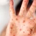 S.C. confirms full-blown outbreak of measles