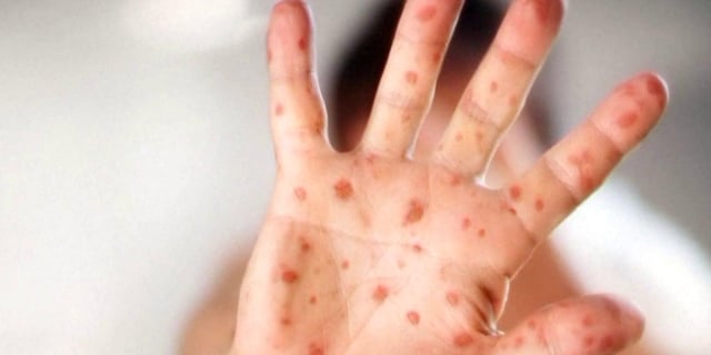 S.C. confirms full-blown outbreak of measles